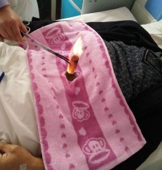脐火治疗