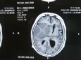 【我们的讲诉】一次伟大的拯救 ——记毕节市中医院神经外科成功挽救巨大脑肿瘤患者的生命