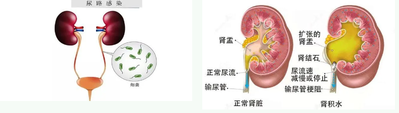 小结石大危害，泌尿系疾病患者的噩梦——尿源性脓毒血症