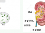 小结石大危害，泌尿系疾病患者的噩梦——尿源性脓毒血症