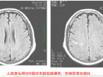 壮年男子反复出现肢体无力，中西医结合治疗后痊愈