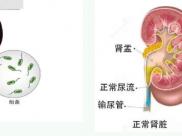 小结石大危害，泌尿系疾病患者的噩梦——尿源性脓毒血症