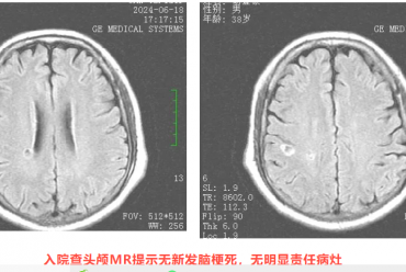 壮年男子反复出现肢体无力，中西医结合治疗后痊愈