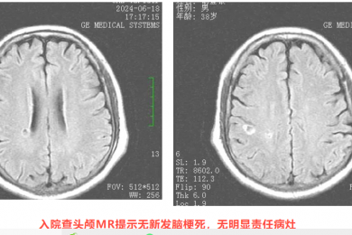 壮年男子反复出现肢体无力，中西医结合治疗后痊愈