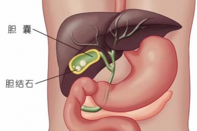 胆囊结石的危害，你真的了解吗？跟毕中医一起了解一下吧
