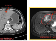 毕节市中医医院成功完成一例腹腔镜胆管癌根治术