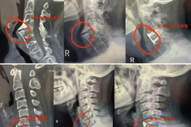 骨伤科“颈”上添花——攻克食管型颈椎病难“咽”之隐