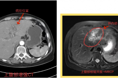 毕节市中医医院成功完成一例腹腔镜胆管癌根治术