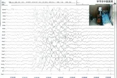 中西合璧，中药联合长程视频脑电提升癫痫诊疗水平
